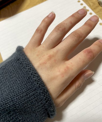 「この発疹の病名わかる方いませんか？ ・手」の質問画像