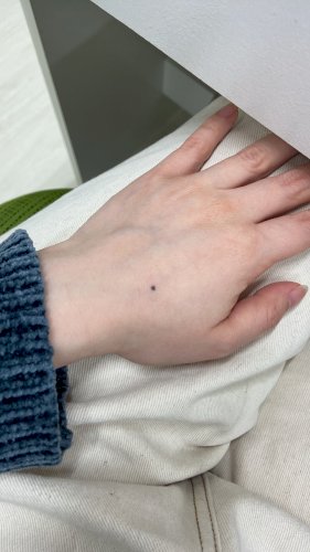 「ほくろが気になります」の質問画像