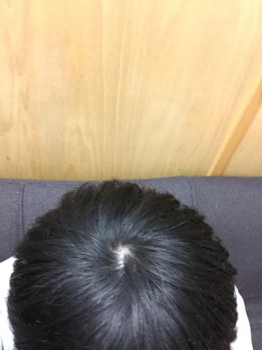 「つむじハゲですか？ 中3男子です」の質問画像