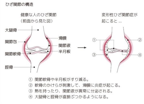 「半月板損傷について」の回答画像2