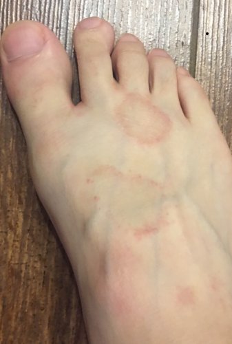 「水虫…なのかな？ 初めて水虫になったかも」の補足画像1