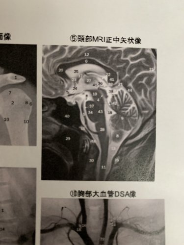 「頭部MRIの正中矢状像です。 番号の解剖」の質問画像