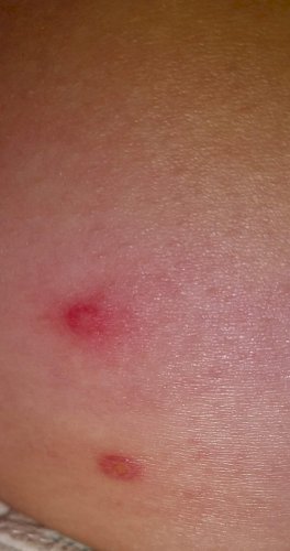 おしりに 一週間前と今日 同じ湿疹が出来ました なんでしょうか 皮膚の病気 アレルギー 教えて Goo おしりに 一週間前と今日 同じ湿疹が出来ました なんでしょうか 皮膚の病気 アレルギー 教えて Goo
