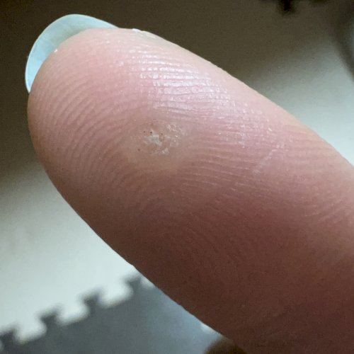「いつのまにか指にこんなものができていまし」の質問画像