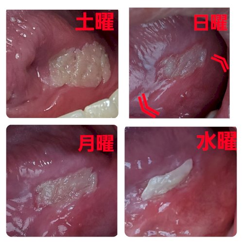 「白板症や舌癌についてわかる方お願いします」の質問画像